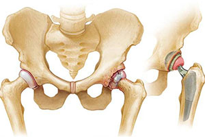 Best Hip and Knee Replacement Surgeon in Andheri