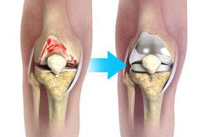 Best Hip and Knee Replacement Surgeon in Andheri